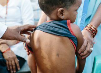 Over 50 children diagnose for leprosy daily – LMN