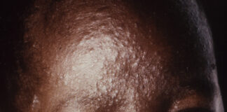 WHO worries as African countries suffer measles outbreak