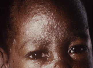 WHO worries as African countries suffer measles outbreak