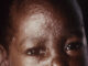 WHO worries as African countries suffer measles outbreak
