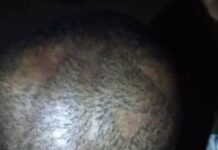 A 10-year-old boy deformed through torture by his step-mother A 10- year old boy deformed through torture by his step-mother