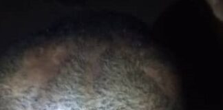 A 10-year-old boy deformed through torture by his step-mother A 10- year old boy deformed through torture by his step-mother