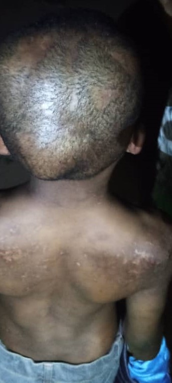 A 10- year old boy deformed through torture by his step-mother
