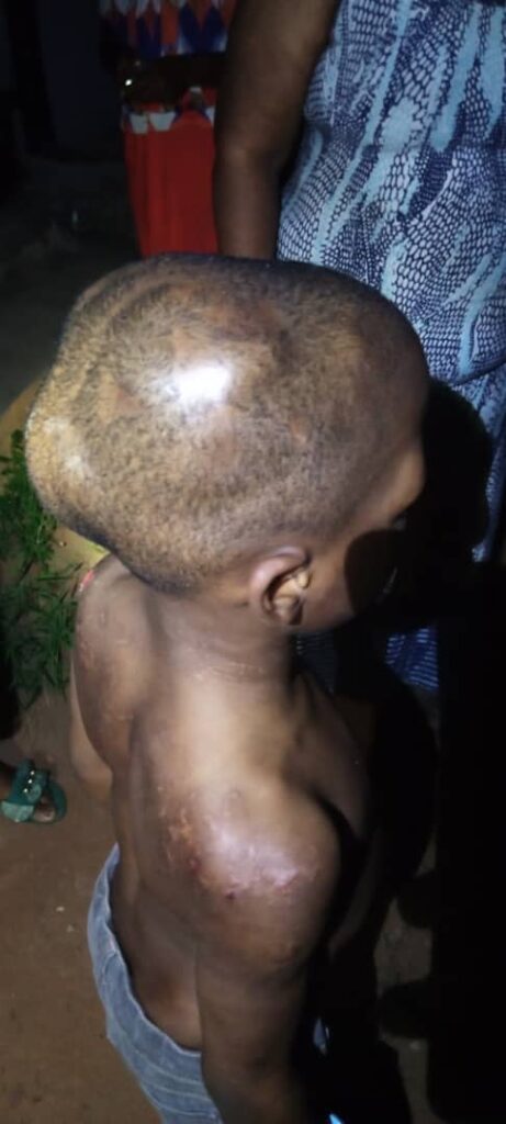 A 10- year old boy deformed through torture by his step-mother