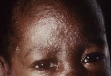 Measles Outbreak: Scores of children feared dead in Rivers State Measles Outbreak: Scores of children feared dead in Rivers State