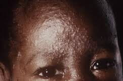 Measles Outbreak: Scores of children feared dead in Rivers State Measles Outbreak: Scores of children feared dead in Rivers State