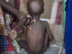 Malnutrition deficiencies affects 20.5m new babies – NESG